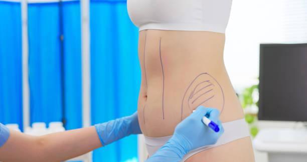 liposuction  in riyadh